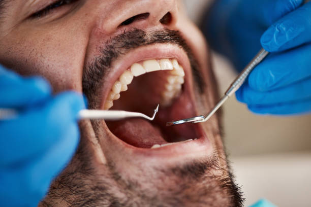 Best Root Canal Treatment  in Shil, OH